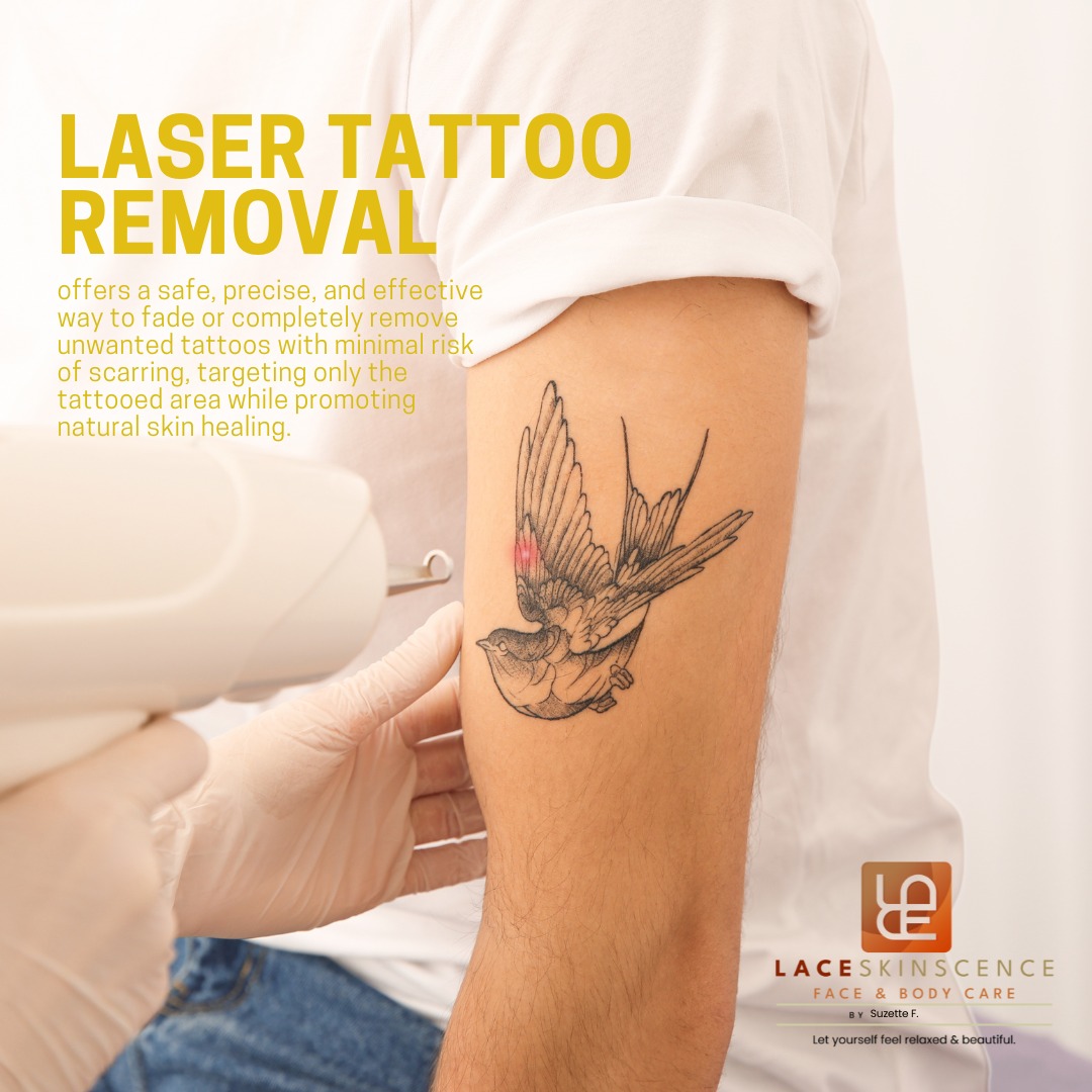 Laser Tattoo Removal